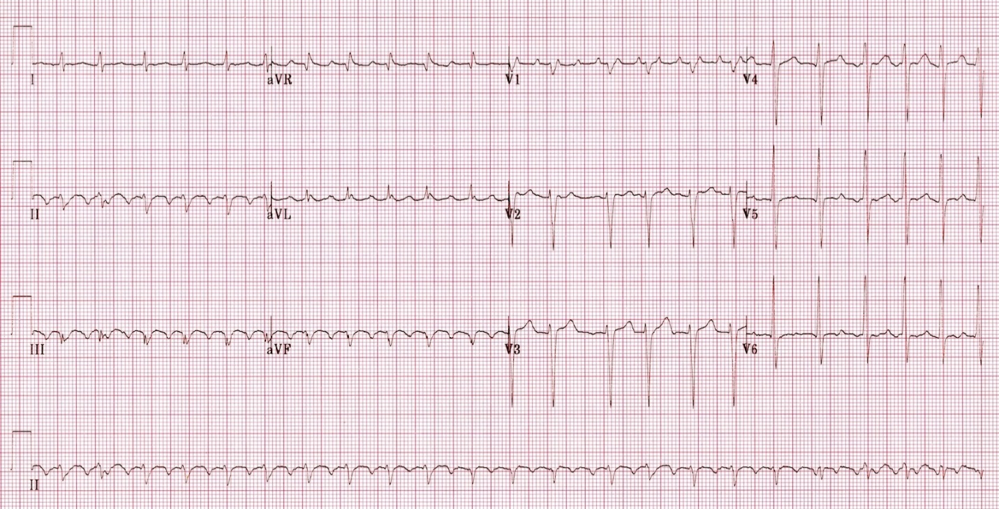 75-year-old man with a history of hypertension