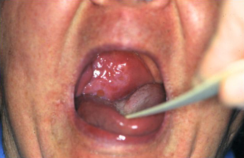 76-year-old woman with pain and difficulty swallowing