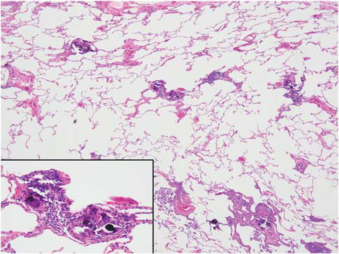 20-year-old college student with prolonged productive cough and fatigue