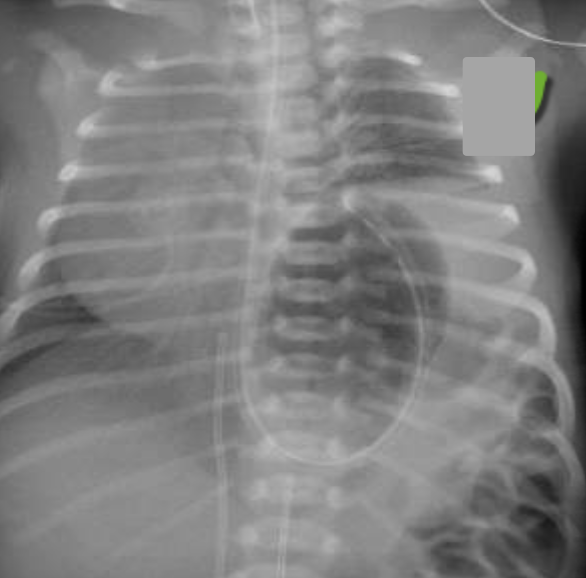 10 day old neonatal boy presents to the ED in respiratory distress