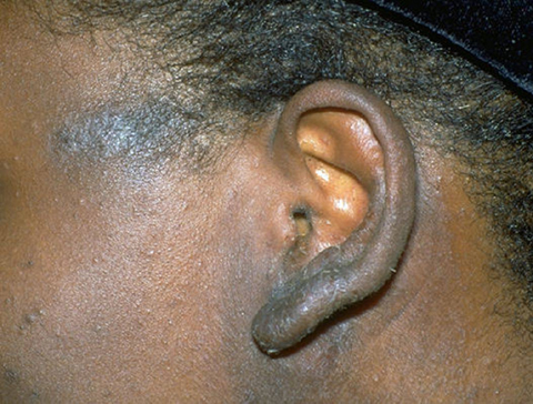 12-year-old boy complains of irritated skin near his auricles