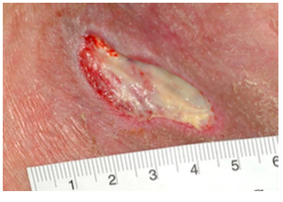 A 75-year-old man with well-controlled diabetes mellitus developed a laceration on his right lower extremity