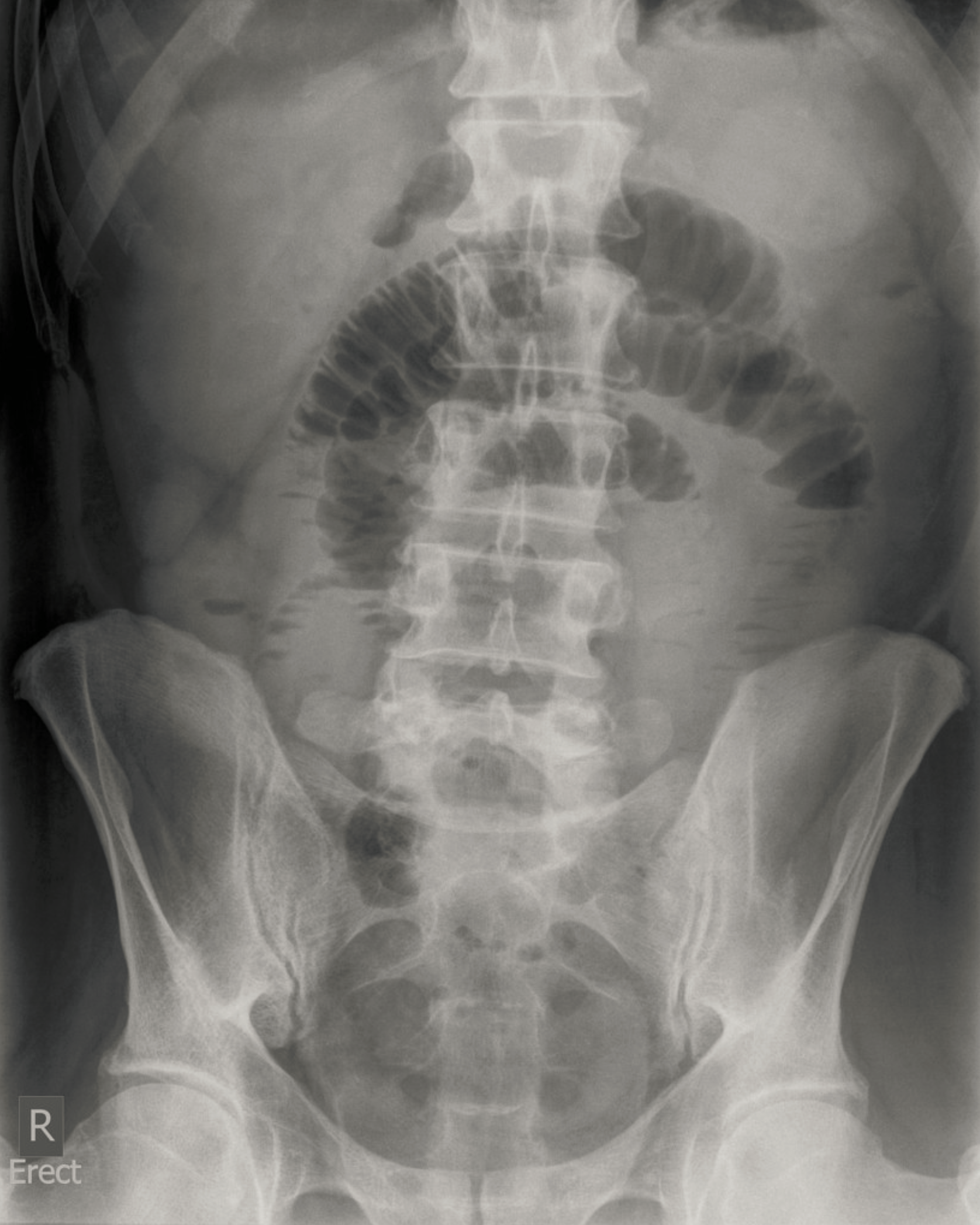 43-year-old man with a prior history of an open appendectomy presents with vomiting, abdominal pain, and distension