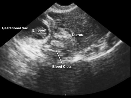 34-year-old gravida 1 para 0 presents with a complaint of abdominal pain