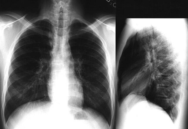 16-year-old male presents with moderately severe acute wheezing