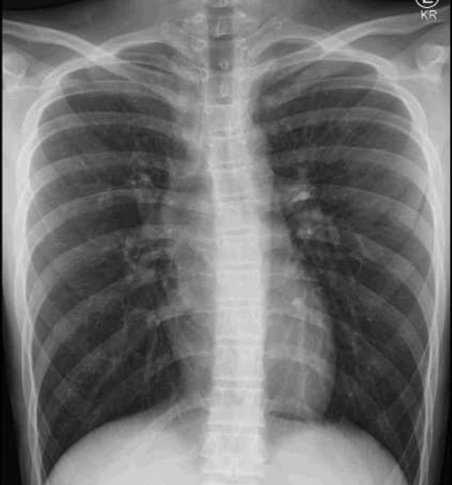 Pediatric Presentation of Acute Onset of Neck and Chest Pain