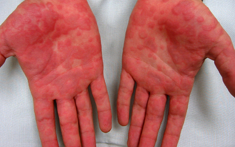 A 14-year-old boy presents with diffuse skin disease