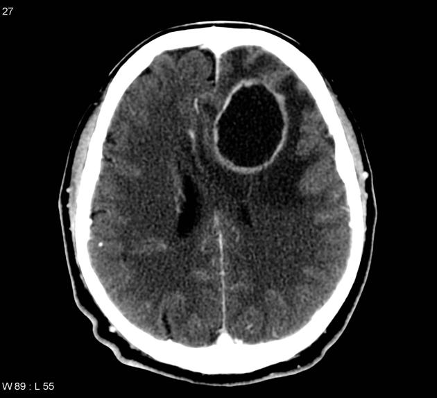 38-year-old man with a history of alcohol abuse presents to you with symptoms of sinusitis