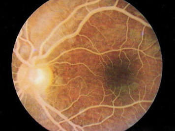 50-year-old man with abnormal funduscopic examination