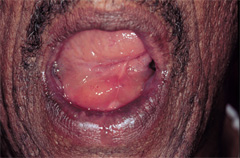 A 68-year-old male presents with right-sided tongue swelling