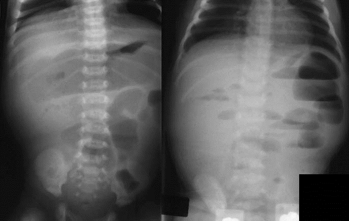 A newborn vomits after each feeding and starts to develop abdominal distension