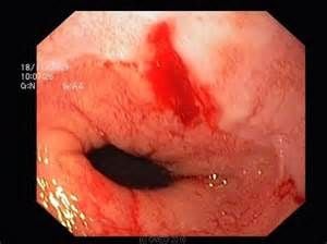 42-year-old presenting with acute heatemesis