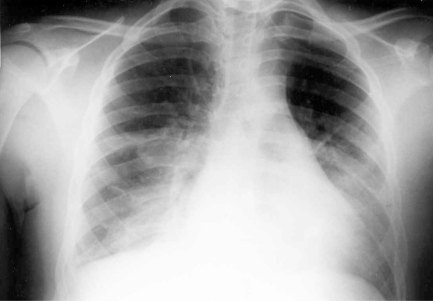 A 12-year-old boy with a known history of asthma presents to the ER with an acute asthma exacerbation