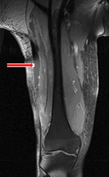 A 62-year-old man with history of type 2 diabetes mellitus