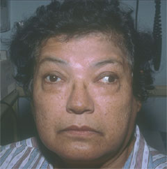 A 60-year-old female complains of double vision when looking straight ahead