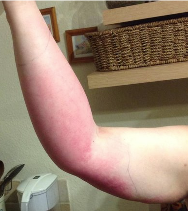 A 32-year-old woman with diabetes presents with a 3 days history of erythema, warmth, edema and pain of her forearm