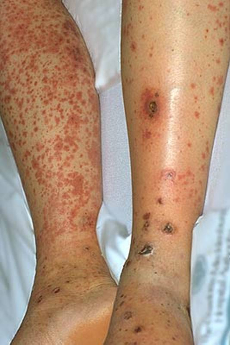 A 46-year-old man taking hydrochlorothiazide presents with a rash