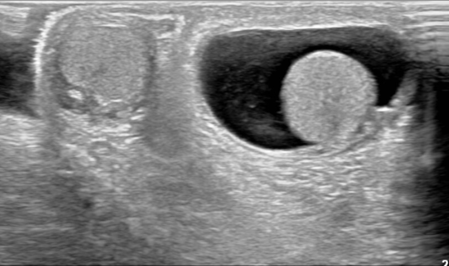 A 2-year old boy presents to the ED with left hemiscrotal swelling