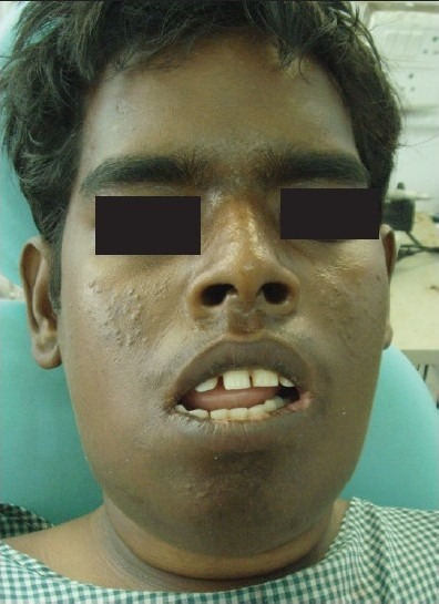 A 27-year-old man with pain, fever, marked swelling in the jaw, and inability to open mouth