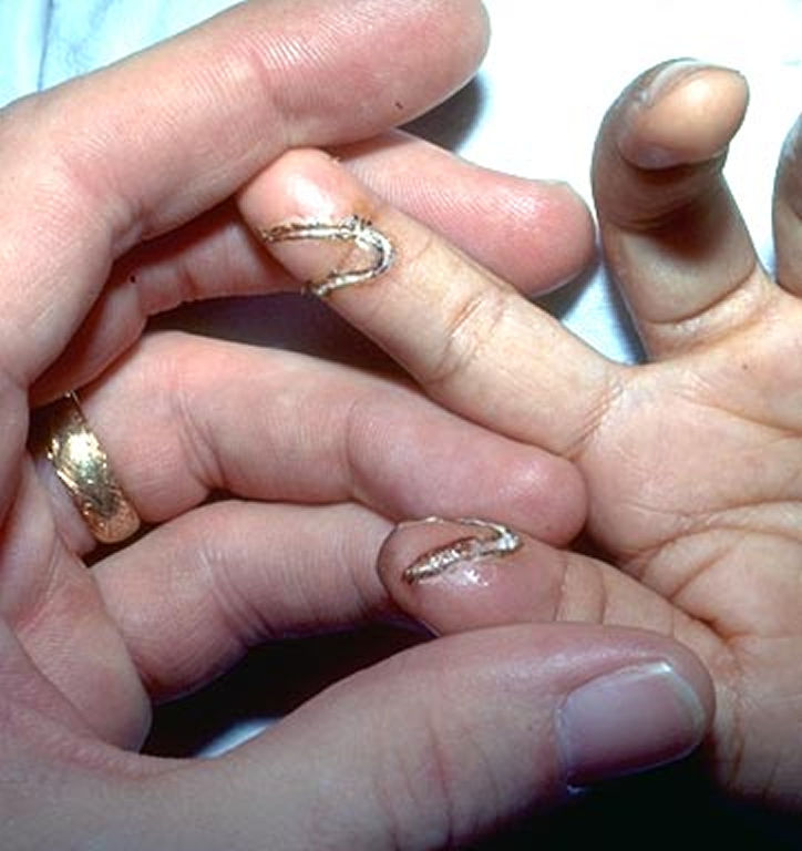 A 3-year-old presents with an injury that occurred while putting a paper clip into an electrical outlet