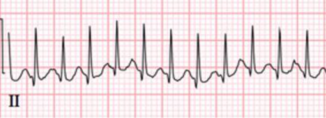 A 6 week old infant is brought to the ED by ambulance for lethargy