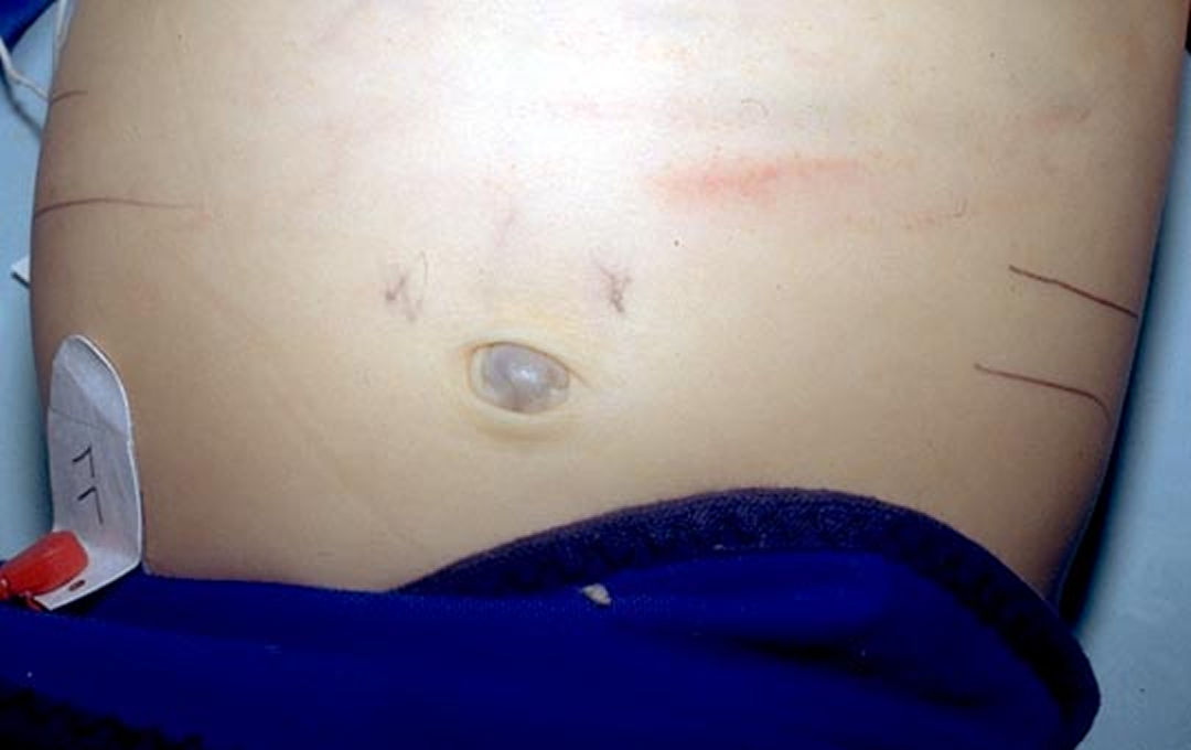 A 12-year-old boy presents to you with abdominal pain