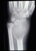 A 40-year-old woman complains of pain and decreased range of motion in her right wrist