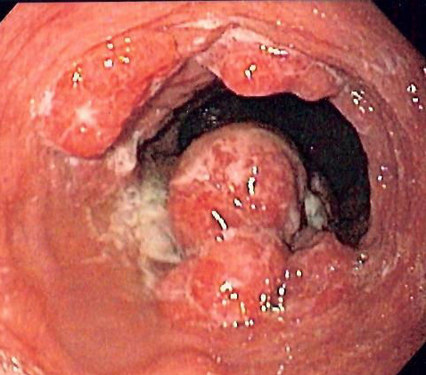 A 61-year-old man presents with dysphagia and weight loss