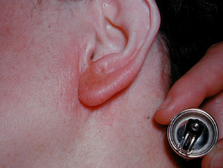 A 14-year-old girl with dermatitis on her earlobe