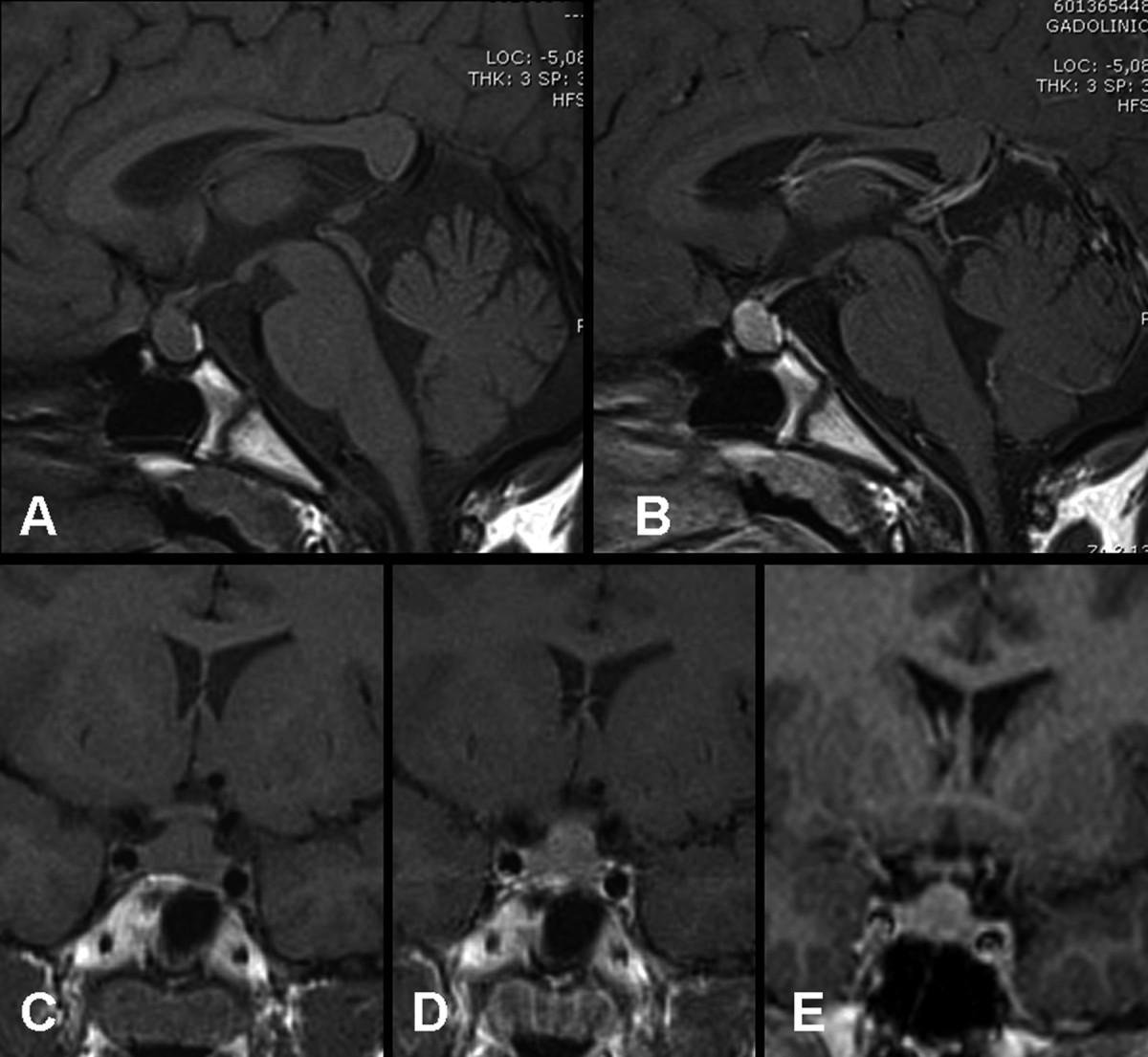 A 32-year-old man complains of frontal headache, weight gain, and cold intolerance